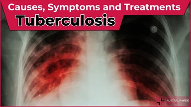 Tuberculosis article header – First Aid Article in Dapto